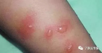 儿童皮肤病防治知识大全,儿童皮肤科护理流程