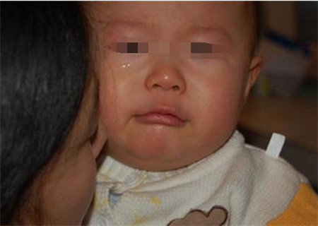 宝宝额头摔个大包一直存在,宝宝额头摔个大包扩散了怎么办