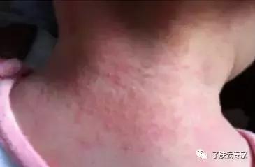 儿童皮肤病防治知识大全,儿童皮肤科护理流程