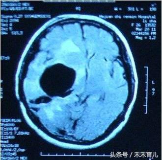 孕检怀疑脑积水,孕晚期侧脑室增宽11需要引产吗