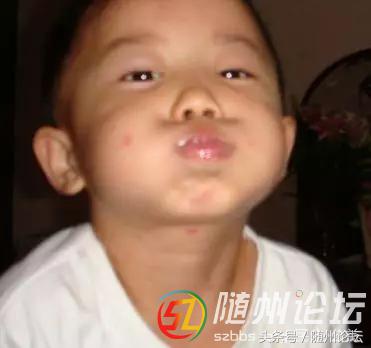 水痘高发期宣传,水痘传染病防控知识宣讲