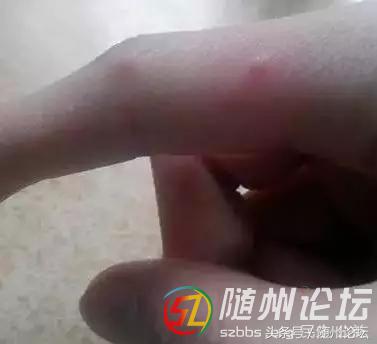水痘高发期宣传,水痘传染病防控知识宣讲