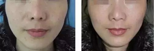 太阳穴凹陷的女人怎么破解,太阳穴凹陷的小妙招