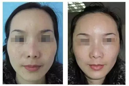 太阳穴凹陷的女人怎么破解,太阳穴凹陷的小妙招