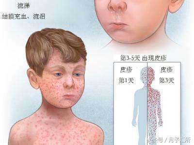 身上都是小红点怎么回事没症状,全身突然起小红点是什么症状