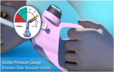 胎儿分娩用吸引器,新生儿难产负压吸引术