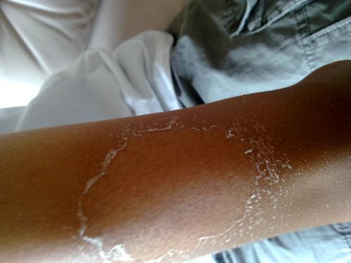 皮肤晒伤修复小妙招