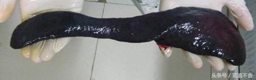 腹痛ct正常需要查肿瘤标志物吗,腹痛死亡三种疾病