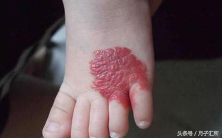身上都是小红点怎么回事没症状,全身突然起小红点是什么症状