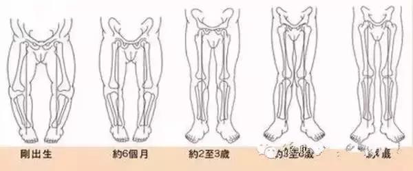 怎么样快速矫正o型腿,在家自己能矫正o型腿吗