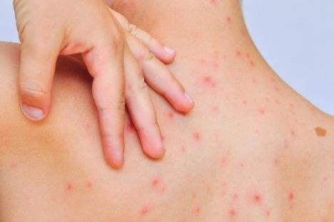 遗传性汗斑皮肤病能彻底治好吗,遗传性皮肤病如何干预