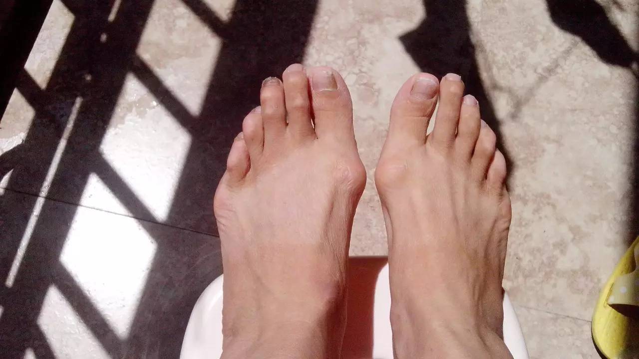 脚趾茧去除最简单方法,脚趾上长了个硬疙瘩像茧怎么去除