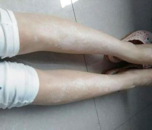 爱美的女人却得了白癜风,女子爱美变白得了白癜风