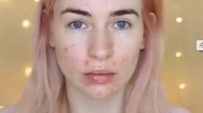 脸上长疮肿了该怎么治,看皮肤科痘痘要问医生什么问题