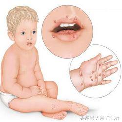 身上都是小红点怎么回事没症状,全身突然起小红点是什么症状