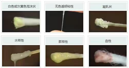 白带常规检查前关注事项,白带出现这三种情况要警惕