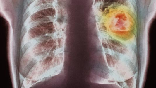 早期肺癌5年生存率能达到92%以上,肺癌真能变成慢性病吗