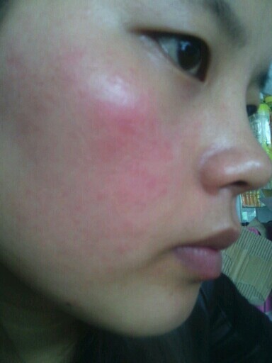 皮肤晒伤修复小妙招