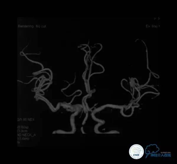天坛周记,天坛医院脑动脉狭窄