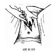 第67课：会阴侧切与撕裂