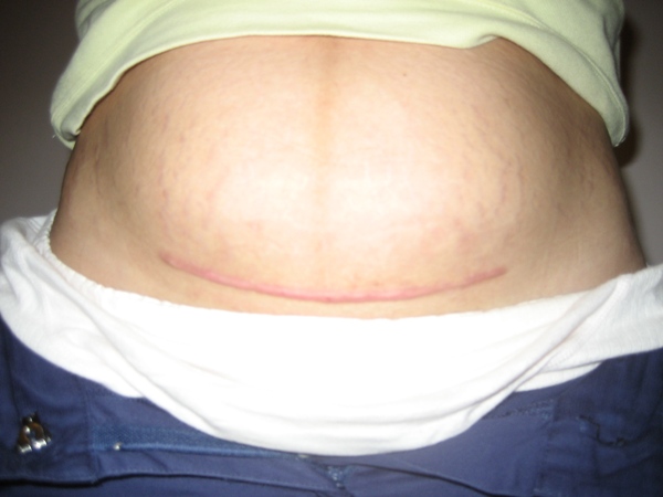 学剖腹产基本操作,剖腹产全课程