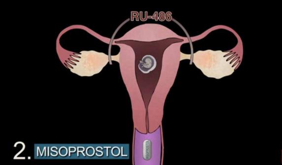 堕胎手术详细流程,女性堕胎手术的可怕真相