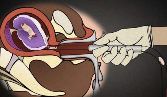 堕胎手术详细流程,女性堕胎手术的可怕真相