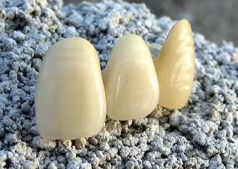 牙医怎么选最好,如何选择适合的烤瓷牙