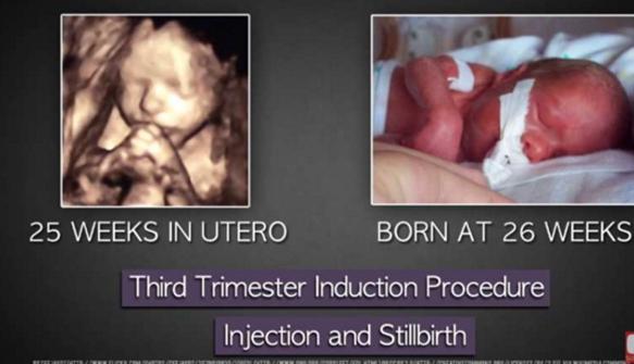 堕胎手术详细流程,女性堕胎手术的可怕真相