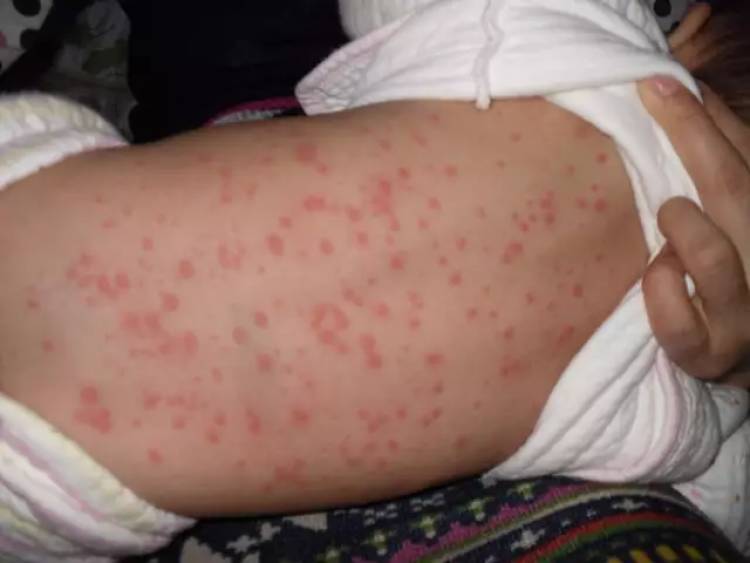 杭州一男子因眼睛奇痒就医，睫毛里竟爬出3条虫！