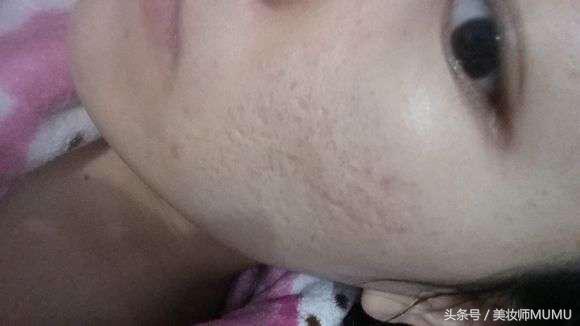 痘坑等于毁容！能修复得好吗？