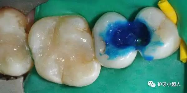 补牙全过程的五个步骤详解,补牙一般需要几步完成