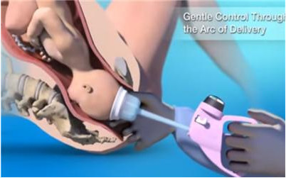 胎儿分娩用吸引器,新生儿难产负压吸引术