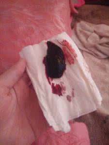 剖腹产后的恶露是大姨妈吗,关于恶露产后宝妈必须要知道的事