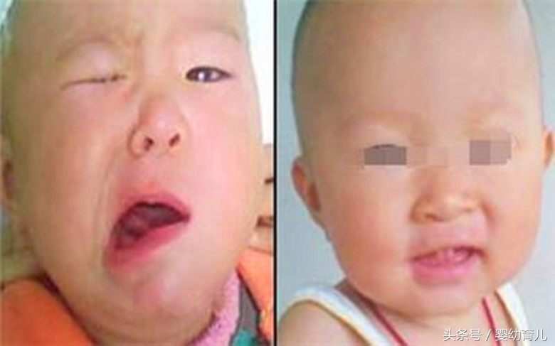 这种电器家里随处可见，却还是有家长忽视致13个月宝宝口眼歪斜