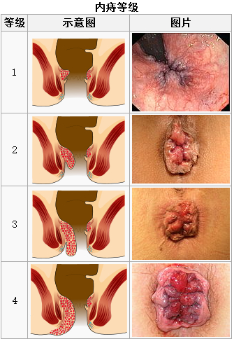 痔疮患者需要知道的必要事项,真正快速治好痔疮的方法