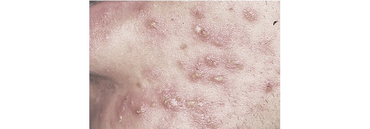 一篇没有噱头不抓眼球但缺切实有用的抗痘护理文章，给有需要的你