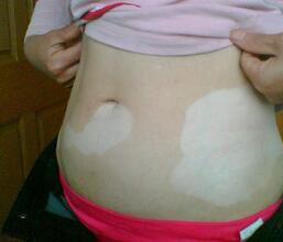 爱美的女人却得了白癜风,女子爱美变白得了白癜风