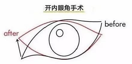 开眼角是把眼睛变大还是变长,开眼角是能让眼睛变长还是变大