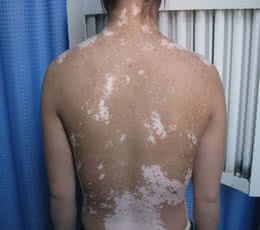 得了白斑怎么治疗？我有办法