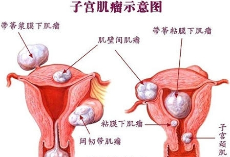 得了子宫肌瘤可以吃百消丹吗,得了子宫肌瘤可以吃豆制品吗