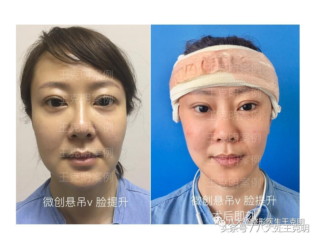 杨紫的法令纹能消除吗,杨紫法令纹很深怎么回事