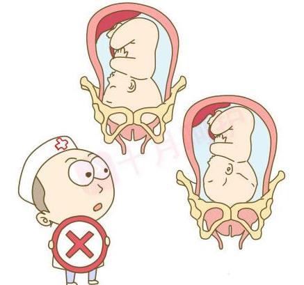 孕妈请关注最容易引起胎儿畸形,孕妈臀位