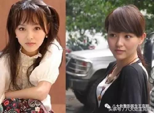 杨紫的法令纹能消除吗,杨紫法令纹很深怎么回事