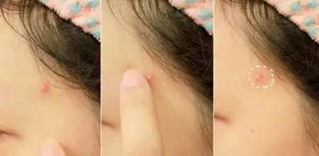 额头长痘痘后要关注哪些？