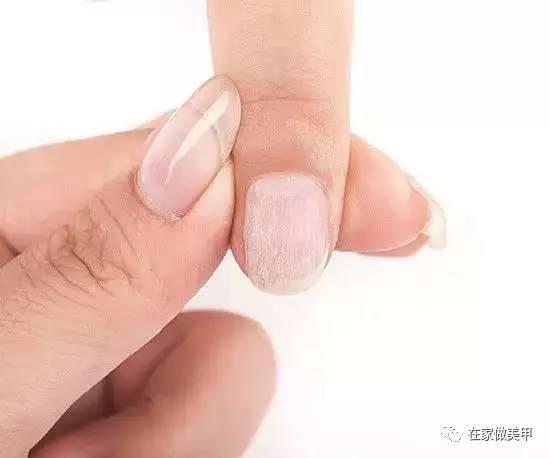 玛蒂被折断手指,玛蒂折断手指