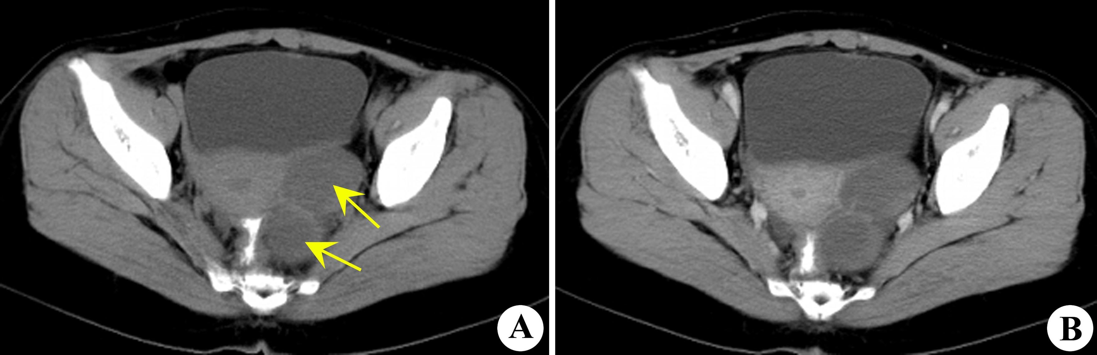 巧克力囊肿7cm要不要手术,做了巧克力囊肿手术要休息多久