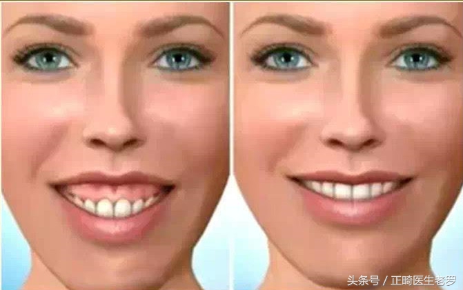 露龈笑矫正危害大吗,露龈笑毁了一辈子