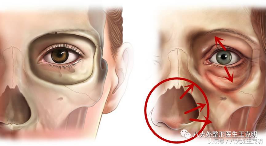 杨紫的法令纹能消除吗,杨紫法令纹很深怎么回事