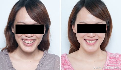 露龈笑矫正危害大吗,露龈笑毁了一辈子
